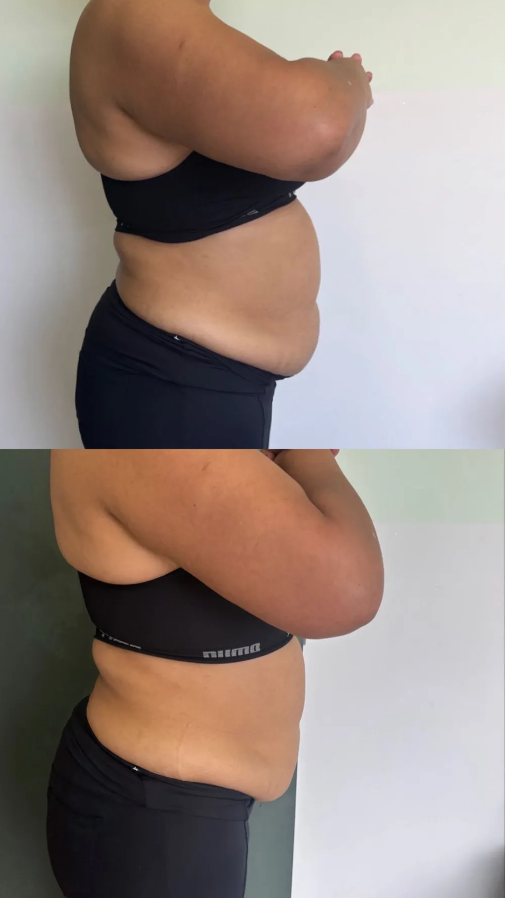 Resultado real de redução de medidas na Slim Beauté
